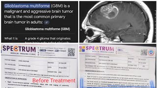 Glioblastoma GBM brain Cancer amp Brain Tumours 71 cm responded by Dr ArpiChopraJainModernHomoeopathy [upl. by Netsirhc66]