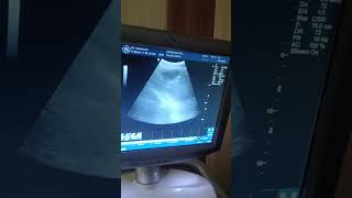 ultrasound me appendix kesi dikhti h appendix appendicitis Inflammation [upl. by Jueta]