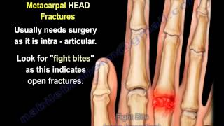 Metacarpal Fractures  Everything You Need To Know  Dr Nabil Ebraheim [upl. by Leen]