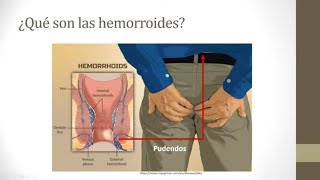 ¿Qué son las hemorroides [upl. by Myk165]