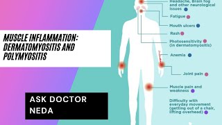 Muscle Inflammatory Disease DermatomyositisPolymyositis Diagnosis and Treatment [upl. by Nohsram]