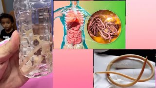 Ascaris lumbricoides roundworms roundworms aiims medicalsurgicalnursing mbbs medical [upl. by Darce]