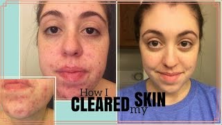 HOW I CLEARED MY SKIN  My Journey with Curology [upl. by Dat883]