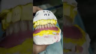 Lower Complete Denture Ready for Flasking 😁😁😁completedentures flaskingfulldenture [upl. by Sabella]