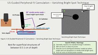 Ultrasoundguided Peripheral IV Access  10 Common Pitfalls [upl. by Atarman]