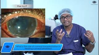 What is the role of corneal transplantation in treating corneal blindness [upl. by Adnilram]