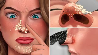 ASMR Satisfying Full Blackhead and Secretions Removal Treatment  Skincare animation [upl. by Gnuh]