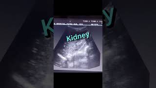 Echogenic Kidney shorts youtube viral [upl. by Aicnerolf]