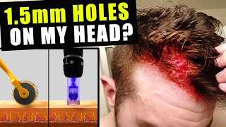 I Cut Thousands Of 15 Millimetre Holes In My Head Every Week To Prevent Hair Loss [upl. by Nah840]