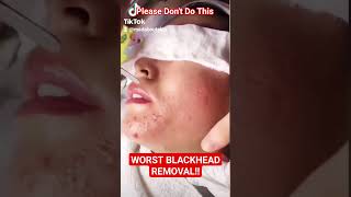 ❌ Worst BLACKHEAD REMOVAL Technique shorts [upl. by Niwrud]