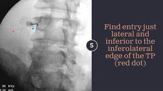 2 Minute Lumbar Transforaminal Epidural Injection [upl. by Ursulette]