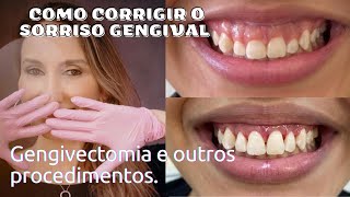 Tratamento para o Sorriso Gengival Gengivectomia Gengivoplastia Aumento de Coroa Clínica Botox [upl. by Amesari815]