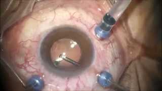 vitrectomy  uveitis [upl. by Imhskal]