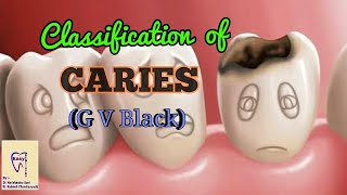 Dental Caries  Classification of dental caries  GV Black Classification [upl. by Valry]