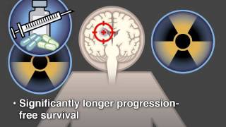 Treatment of LowGrade Glioma [upl. by Yesmar]