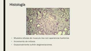 27MIOMATOSIS UTERINA●DRDUEÑAS [upl. by Gamin]