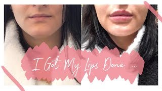 I GOT LIP FILLERS  Getting 1ml of Juvederm Volift  beckyloubutton [upl. by Carry]