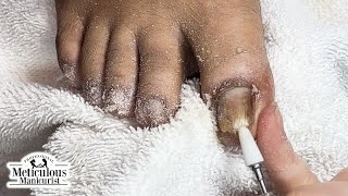 Fix Thick and Discolored Toenails nails satisfying [upl. by Htebezile]