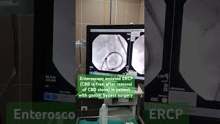 Enteroscopy assisted ERCPCBD is freeafter removal of CBD stonepatient with gastric bypass surgery [upl. by Cnut429]