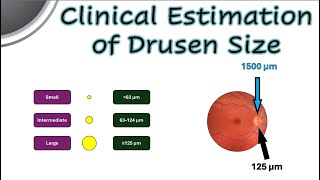 Clinical Estimation of Drusen Size [upl. by Belita]