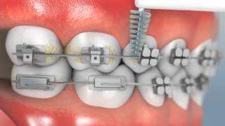 Interproximal Brushing [upl. by Esinal]