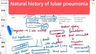 Natural history of lobar pneumonia Respiratory 50  First Aid USMLE Step 1 in UrduHindi [upl. by Launamme924]