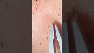 relaxing plucking pluck satisfying tweezer hair ingrownhair plucky chin hairproblem pcos [upl. by Gavriella462]