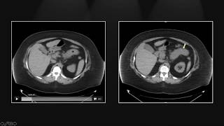 Small Bowel Emergencies  Interesting Radiology Cases [upl. by Borchers]