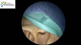 Endoscopic Myringotomy and Ventilation Tube Insertion [upl. by Rechaba166]