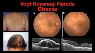 VogtKoyanagiHarada Disease VKH  Swelling of the Eye and the Body [upl. by Ulphi]