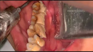 Tartar removal teeth at home  Tartar removal teeth at home [upl. by Ethelstan]