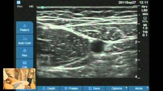 Ultrasound guided obturator and saphenous nerve block workshop [upl. by Mindy]