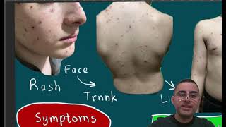 Chickenpox  Signs Symptoms Treatment How long does chicken pox last [upl. by Anigroeg]