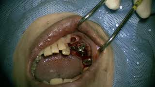 Straumann NC RN WN place in posterior mandible 4 [upl. by Renato]