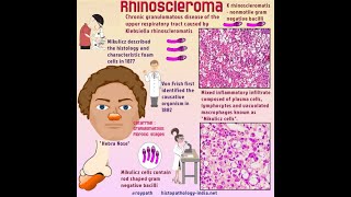 actinomyosis amp rhinsleroma granuloma 3 s [upl. by Auqenes]