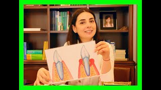 Periodontitis nedir  Küretaj tedavisi kimlere ve nasıl yapılır [upl. by Quackenbush]