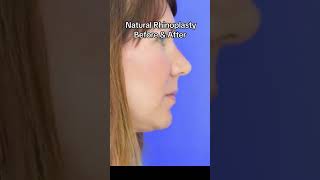 Rhinoplasty before amp after [upl. by Ameline]