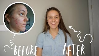 HOW TO GET RID OF ACNE  One month on Doxycycline [upl. by Hanikahs84]