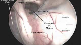 Endoscopic Third Ventriculostomy [upl. by Retsbew]