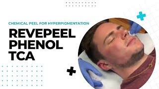 Chemical Peel for Hyperpigmentation  RevePeel Phenol TCA  Dr Jason Emer [upl. by Clay]