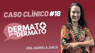 Dermato pra Dermato 18  Caso Clínico [upl. by Ybrad]