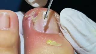 Removing Infected Ingrown Toenails [upl. by Selim]