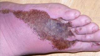 FOOT Picture Cellulitis  Rattle my cage Rehab [upl. by Portingale]