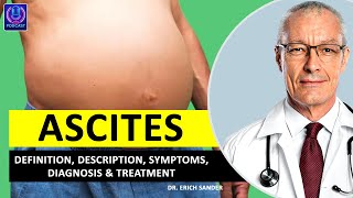 ASCITES Definition Description Causes and symptoms Diagnosis amp Treatment of Ascites [upl. by Linneman41]