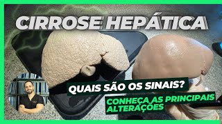 Cirrose Hepática Anatomia Sintomas e Tratamento com Demonstração Prática [upl. by Artinak]