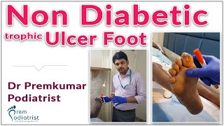 Non diabetic trophic ulcer foot DrPremkumar Podiatric surgeon  Dr Prems Diabetic Foot [upl. by Renaldo919]