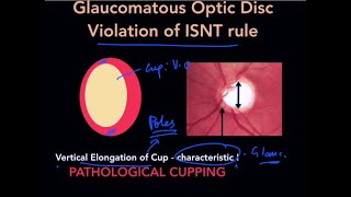 High Yield Topic  Optic Disc Changes in Glaucoma  The Complete Course [upl. by Erdreid]