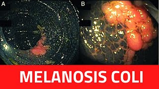 What is Melanosis Coli  Melanosis Coli CausesTreatment LaxativesBiopsyDiagnosis [upl. by Nalehp637]