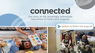 update on Pedro and Augusto separated conjoined twins from connected documentary [upl. by Witherspoon]