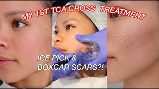 TCA CROSS FOR ACNE SCARS l Ice pick amp Boxcar scars on Asian Skin [upl. by Adlare]